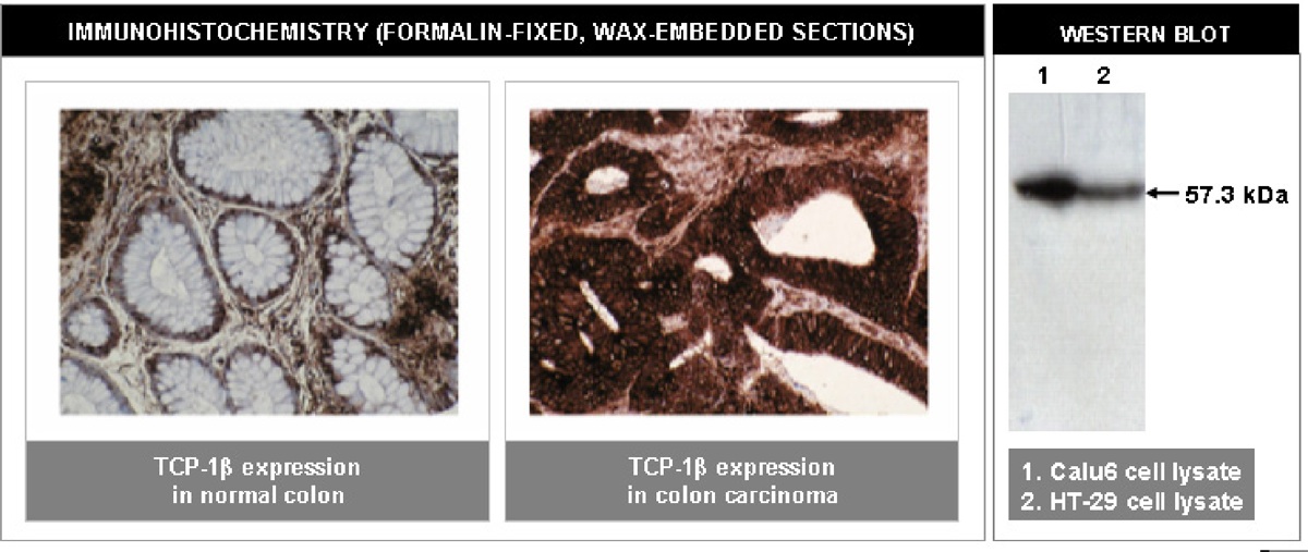"Left and Center: Immunohistochemical staining of normal (left) and cancerous (center) colon tissue using TCP-1β antibody (Cat. No. X2069M).
Right: Western blot analysis using TCP-1β antibody on Calu6 (1) and HT-29 (2) cell lysates."
